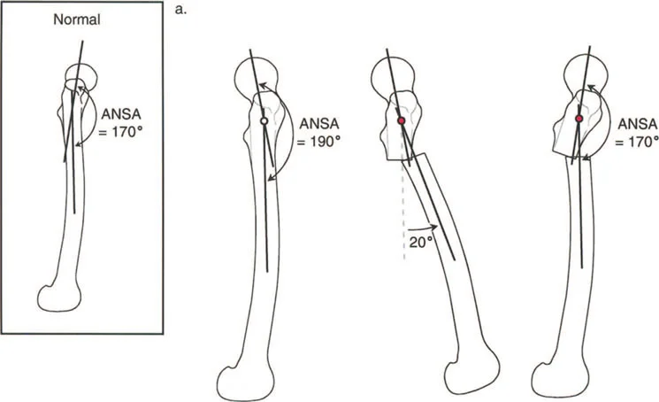 صورة طبية: دليلك الشامل لتصحيح تشوهات مفصل الورك: من التشخيص إلى التعافي مع الأستاذ الدكتور محمد هطيف في صنعاء