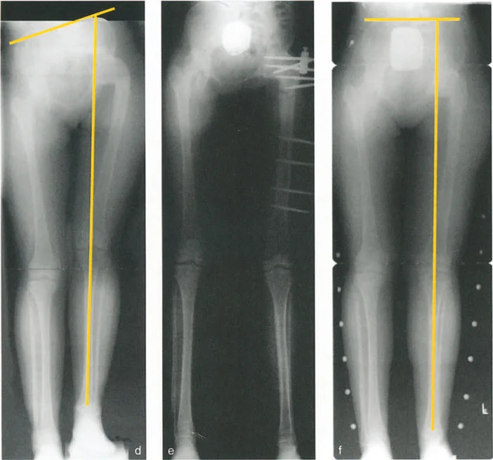 صورة طبية: دليلك الشامل لتصحيح تشوهات مفصل الورك: من التشخيص إلى التعافي مع الأستاذ الدكتور محمد هطيف في صنعاء