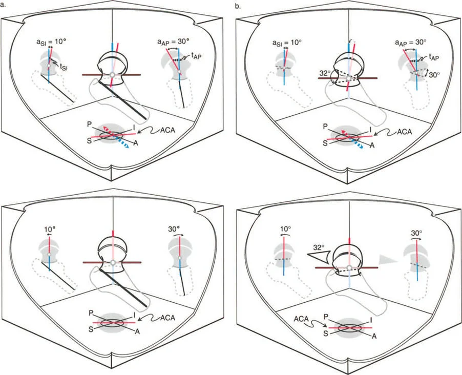 صورة توضيحية لتشوهات مفصل الورك