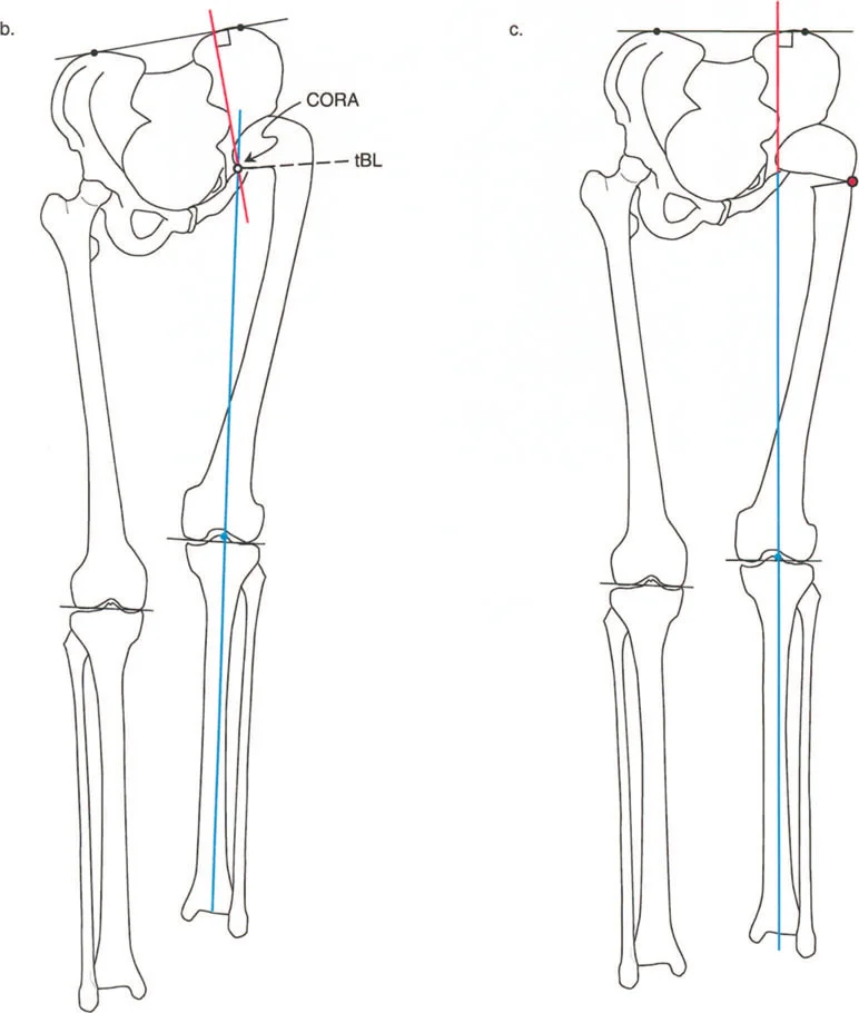 صورة طبية: دليلك الشامل لتصحيح تشوهات مفصل الورك: من التشخيص إلى التعافي مع الأستاذ الدكتور محمد هطيف في صنعاء