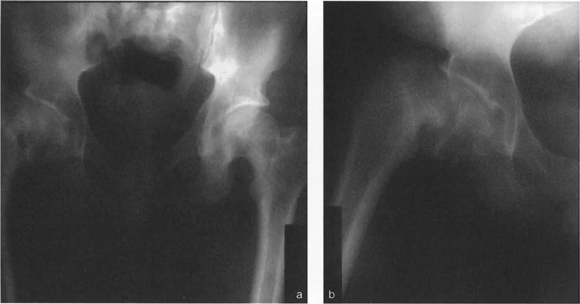 صورة توضيحية لـ دليلك الشامل لتصحيح تشوهات مفصل الورك: من التشخيص إلى التعافي مع الأستاذ الدكتور محمد هطيف في صنعاء