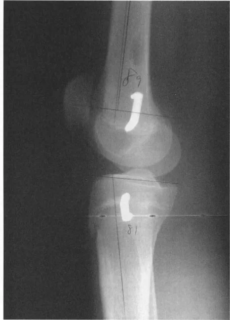 صورة توضيحية لـ صفائح النمو وتفاوت طول الأطراف: دليل شامل للتنبؤ والعلاج في صنعاء