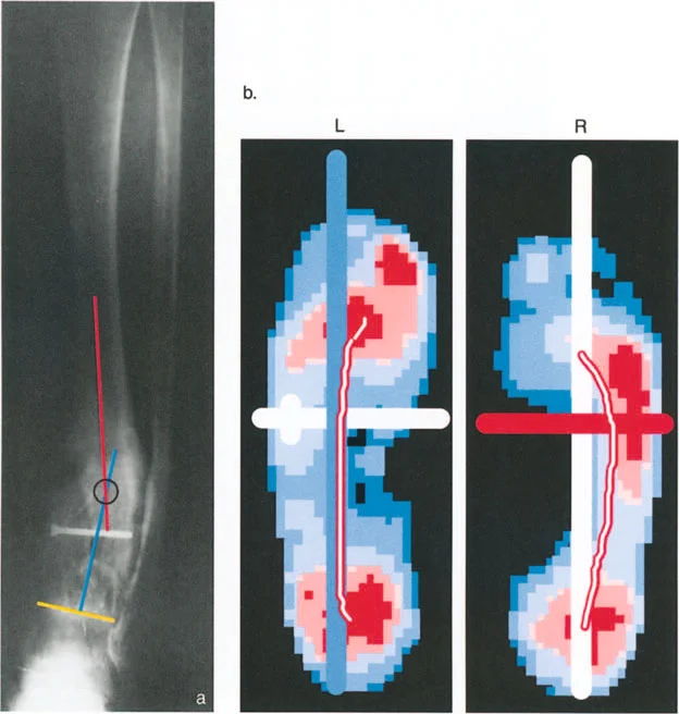 صورة توضح تشوه الكاحل وتأثيره على الركبة
