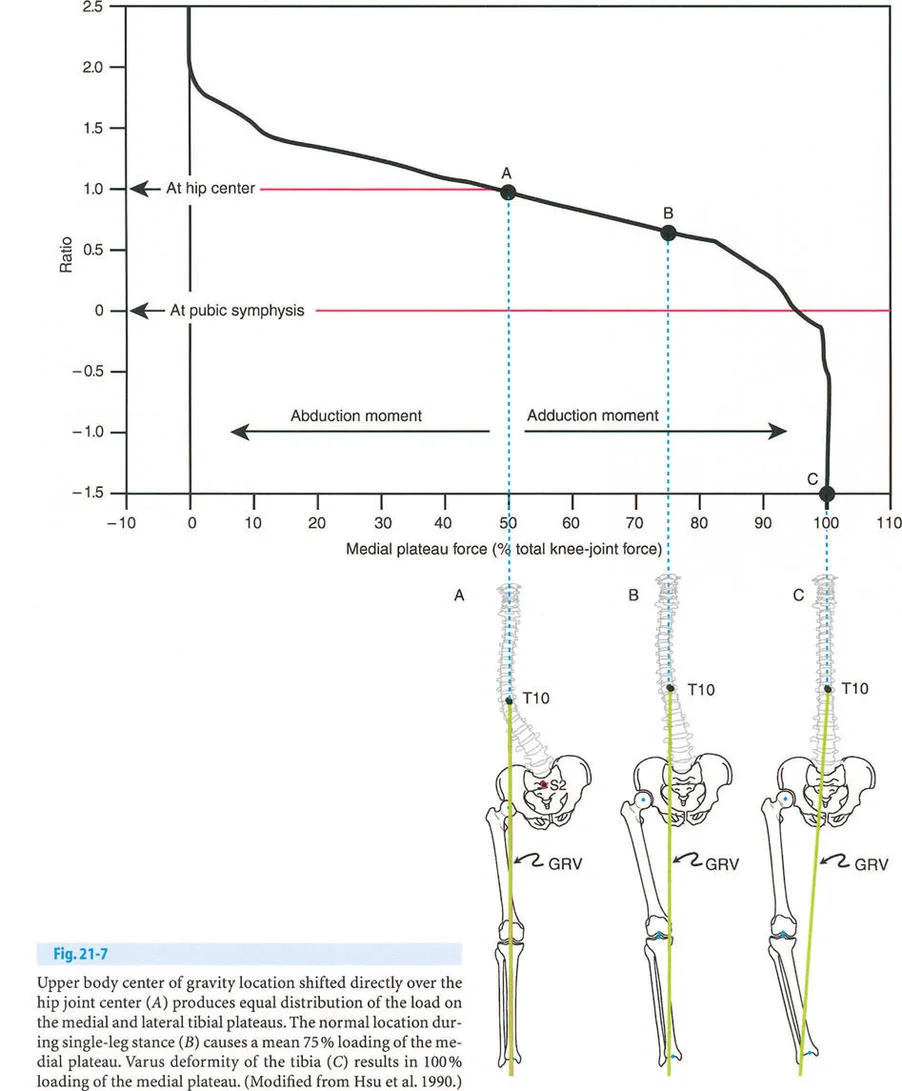 إتقان ميكانيكا المشي الحيوية وتصحيح تشوهات الأطراف السفلية: نهج الأستاذ الدكتور محمد هطيف في صنعاء
