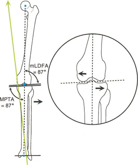 صورة توضح تشوه التقوس وتأثيره على الركبة