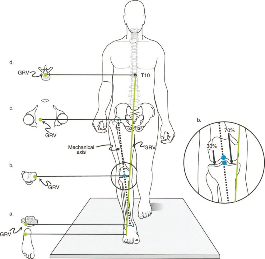صورة توضيحية لـ إتقان ميكانيكا المشي الحيوية وتصحيح تشوهات الأطراف السفلية: نهج الأستاذ الدكتور محمد هطيف في صنعاء
