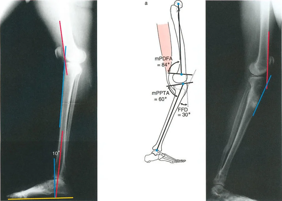 صورة توضيحية لـ إتقان ميكانيكا المشي الحيوية وتصحيح تشوهات الأطراف السفلية: نهج الأستاذ الدكتور محمد هطيف في صنعاء
