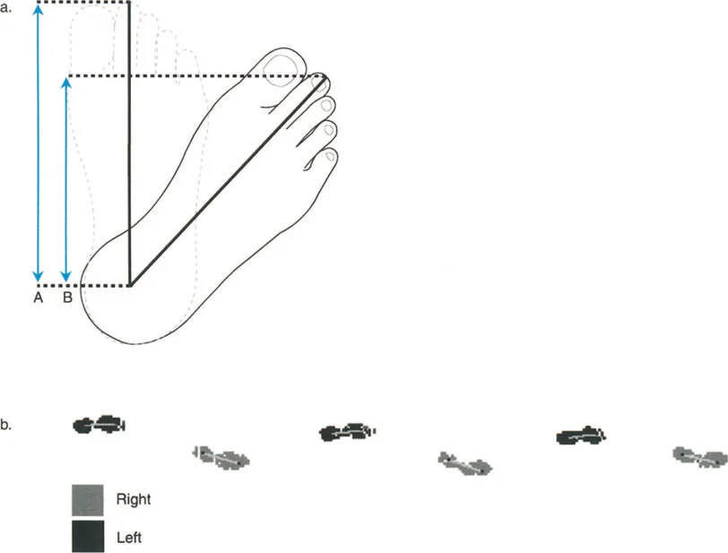 صورة طبية: إتقان ميكانيكا المشي الحيوية وتصحيح تشوهات الأطراف السفلية: نهج الأستاذ الدكتور محمد هطيف في صنعاء