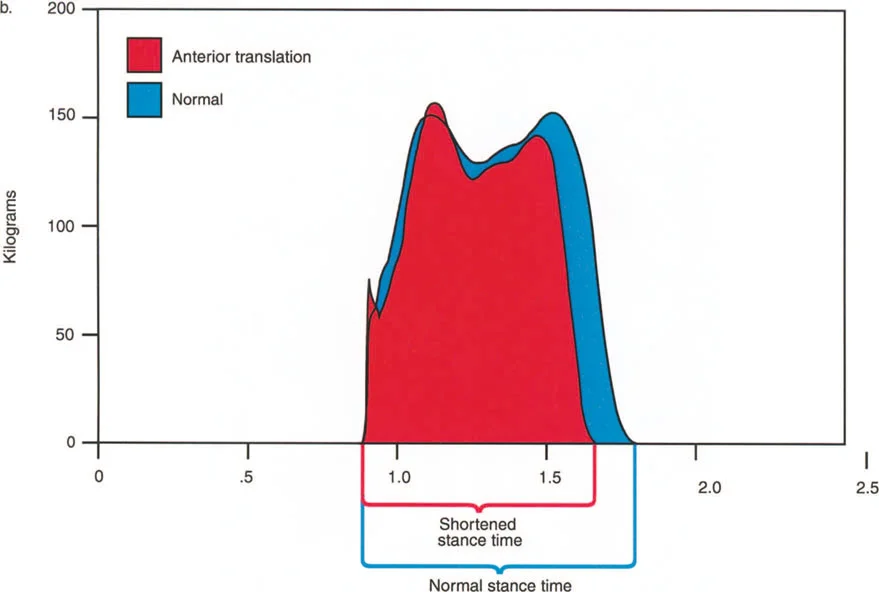 صورة طبية: إتقان ميكانيكا المشي الحيوية وتصحيح تشوهات الأطراف السفلية: نهج الأستاذ الدكتور محمد هطيف في صنعاء