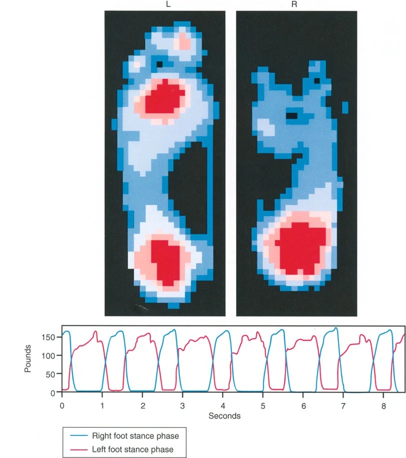 صورة توضح تشوه الركبة الخلفية في الساق