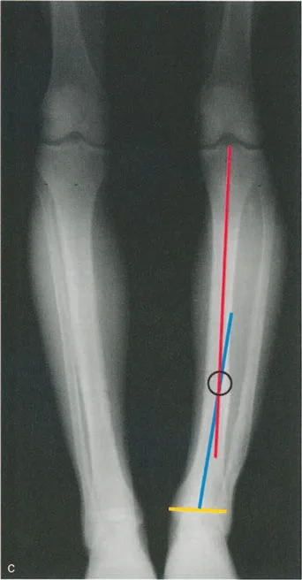 صورة توضح تحميل المفصل غير الطبيعي