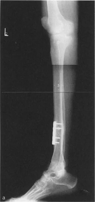 صورة طبية: إتقان ميكانيكا المشي الحيوية وتصحيح تشوهات الأطراف السفلية: نهج الأستاذ الدكتور محمد هطيف في صنعاء