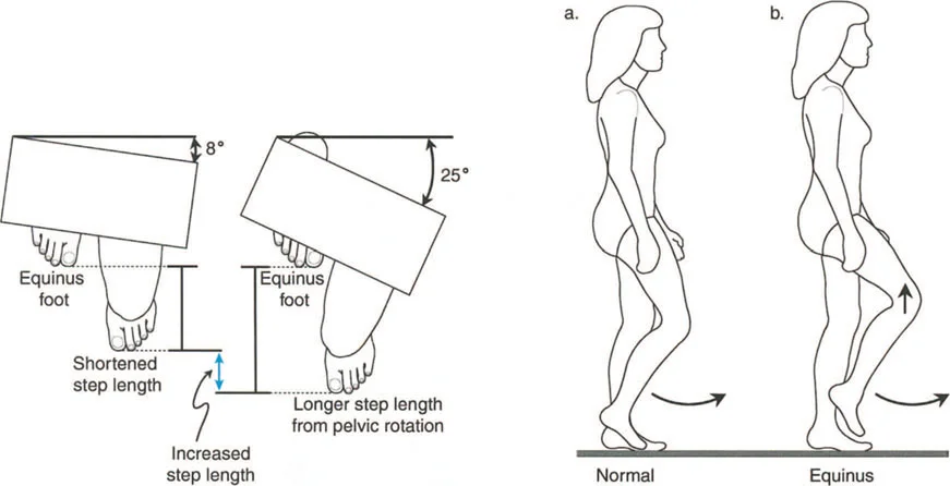 صورة طبية: إتقان ميكانيكا المشي الحيوية وتصحيح تشوهات الأطراف السفلية: نهج الأستاذ الدكتور محمد هطيف في صنعاء