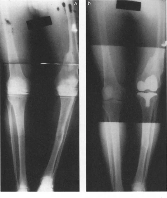 صورة طبية: فهم وعلاج التشوهات الديناميكية وخلل ميكانيكا الأذرع الرافعة في جراحة العظام مع الأستاذ الدكتور محمد هطيف