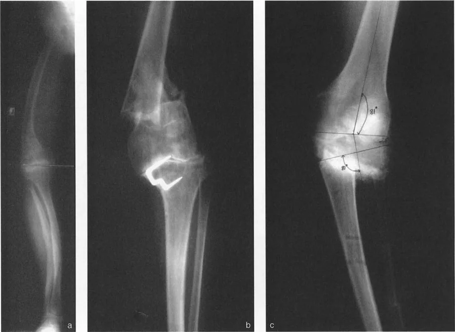 صورة طبية: فهم وعلاج التشوهات الديناميكية وخلل ميكانيكا الأذرع الرافعة في جراحة العظام مع الأستاذ الدكتور محمد هطيف