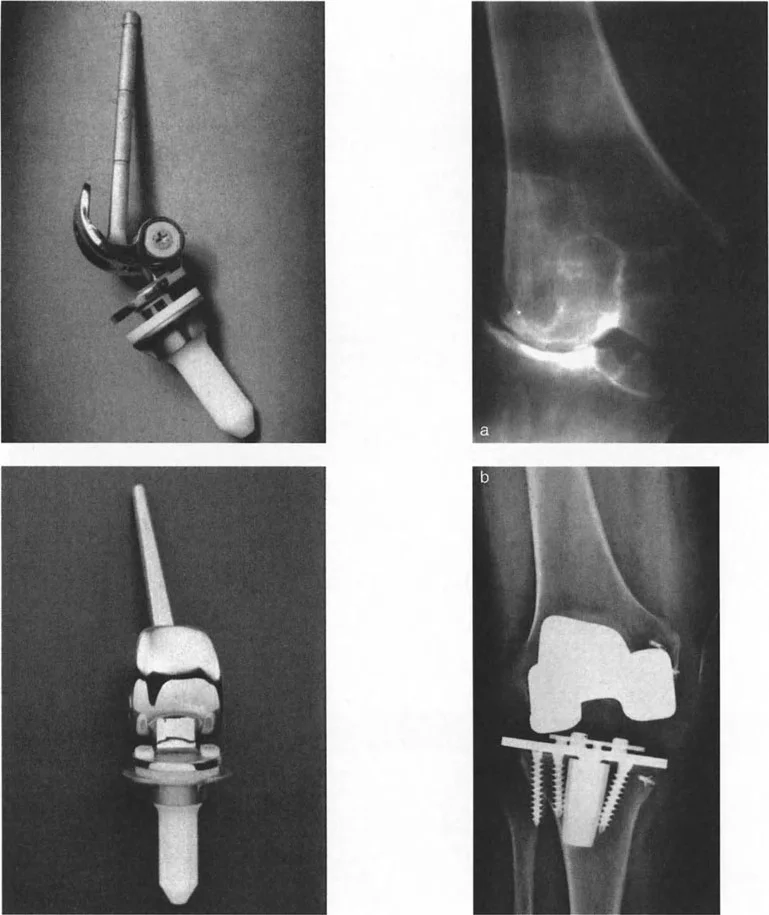 صورة طبية: فهم وعلاج التشوهات الديناميكية وخلل ميكانيكا الأذرع الرافعة في جراحة العظام مع الأستاذ الدكتور محمد هطيف