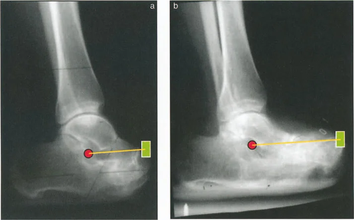 صورة توضيحية لـ فهم وعلاج التشوهات الديناميكية وخلل ميكانيكا الأذرع الرافعة في جراحة العظام مع الأستاذ الدكتور محمد هطيف