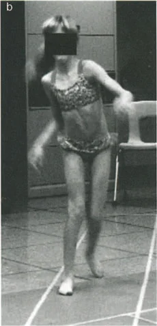 فهم وعلاج التشوهات الديناميكية وخلل ميكانيكا الأذرع الرافعة في جراحة العظام مع الأستاذ الدكتور محمد هطيف