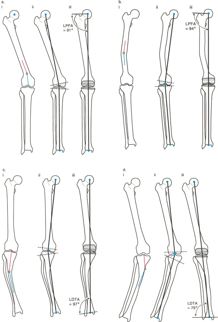 طفل يعاني من حنف القدم الوظيفي