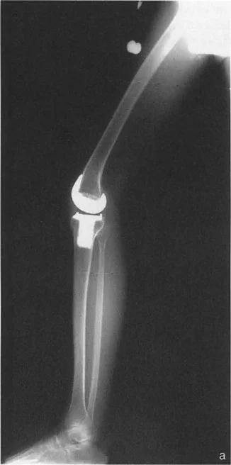 صورة طبية: فهم وعلاج التشوهات الديناميكية وخلل ميكانيكا الأذرع الرافعة في جراحة العظام مع الأستاذ الدكتور محمد هطيف