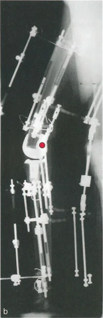 صورة طبية: فهم وعلاج التشوهات الديناميكية وخلل ميكانيكا الأذرع الرافعة في جراحة العظام مع الأستاذ الدكتور محمد هطيف