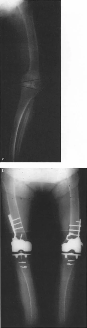 صورة طبية: فهم وعلاج التشوهات الديناميكية وخلل ميكانيكا الأذرع الرافعة في جراحة العظام مع الأستاذ الدكتور محمد هطيف