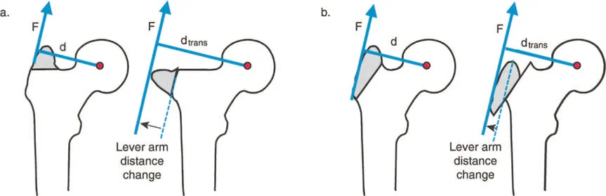 صورة طبية: فهم وعلاج التشوهات الديناميكية وخلل ميكانيكا الأذرع الرافعة في جراحة العظام مع الأستاذ الدكتور محمد هطيف