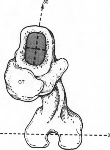 صورة توضيحية لـ استبدال مفصل الركبة والورك المعقد في حالات التشوه الشديد: دليل المريض الشامل