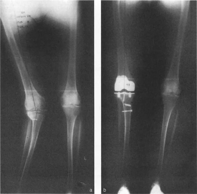 صورة توضيحية لـ استبدال مفصل الركبة والورك المعقد في حالات التشوه الشديد: دليل المريض الشامل