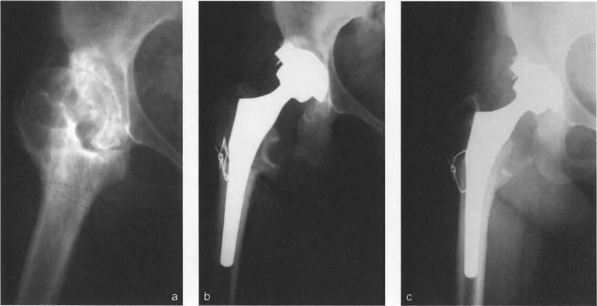 Mastering Arthroplasty in Severe Malalignment: TKR and THR Deformity Correction