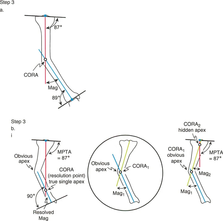 صورة توضيحية لـ تصحيح تشوهات الأطراف السفلية الكلي: دليل شامل للتخطيط الدقيق والعلاج المتقدم في صنعاء مع الأستاذ الدكتور محمد هطيف