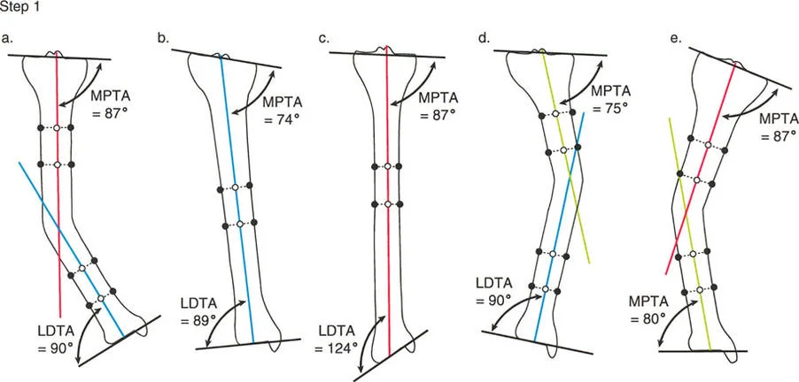 تصحيح تشوهات عظام الساق والمحور الميكانيكي: دليل المريض الشامل