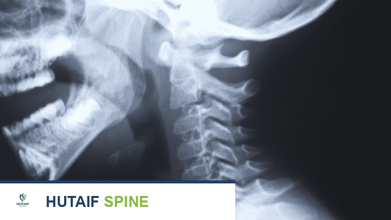 التعافي الشامل بعد جراحة استبدال القرص الصناعي العنقي: من 3 أسابيع إلى 3 أشهر وما بعدها مع الأستاذ الدكتور محمد هطيف
