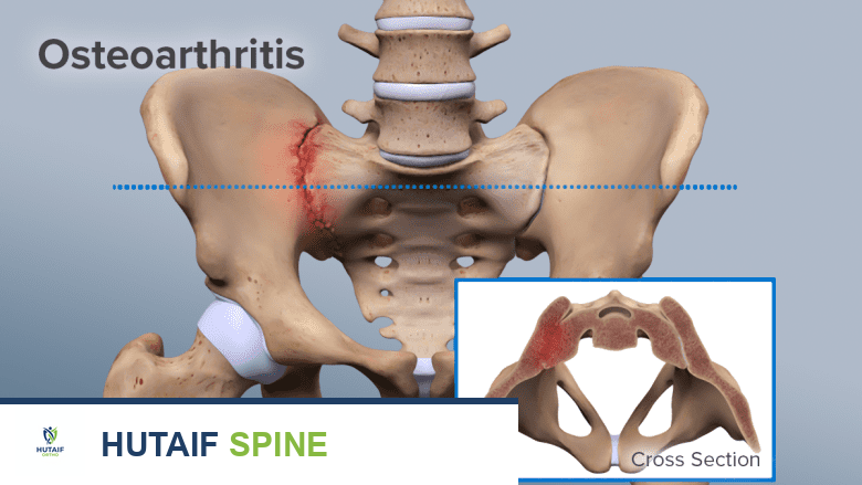 تصوير يوضح منطقة الحوض مع المفصل العجزي الحرقفي باللون الأحمر ومقطع عرضي لعظم الحوض