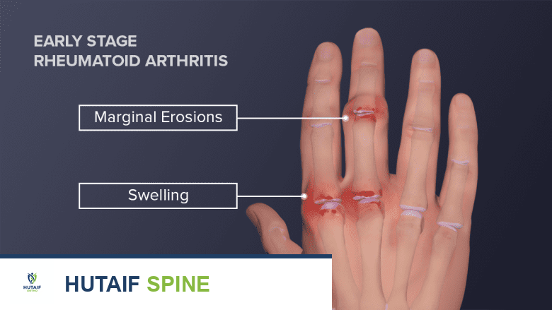 تصوير يوضح يدًا تظهر تآكلات هامشية في الأصابع