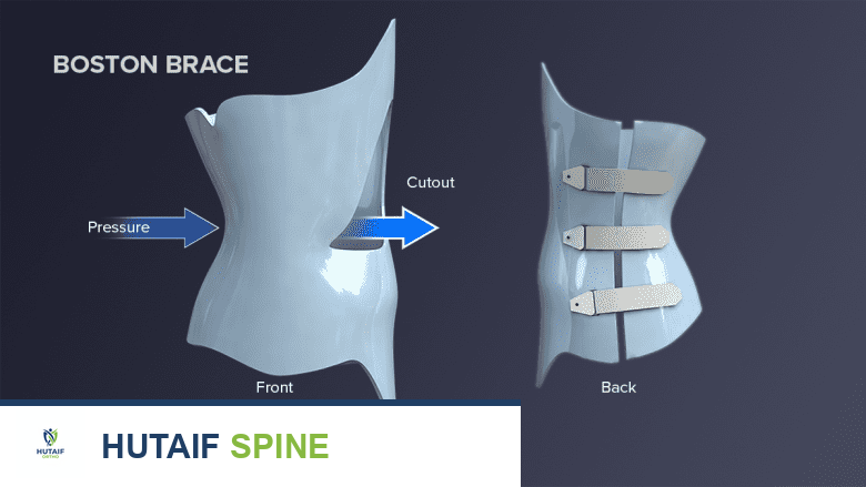 الجنف المراهق مجهول السبب والصحة العاطفية: دليل شامل للآباء والمراهقين