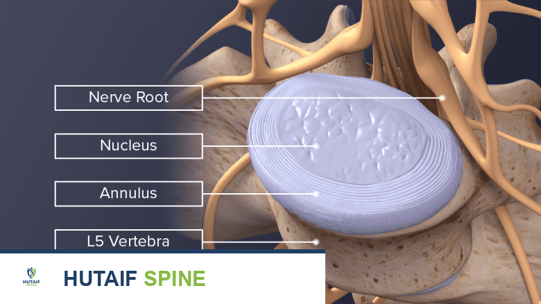 منظر علوي مصنف لقرص L4-L5 طبيعي