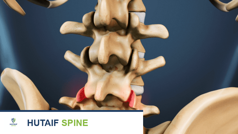 خشونة فقرات الظهر والرقبة الأسباب الأعراض والعلاج مع الأستاذ الدكتور محمد هطيف