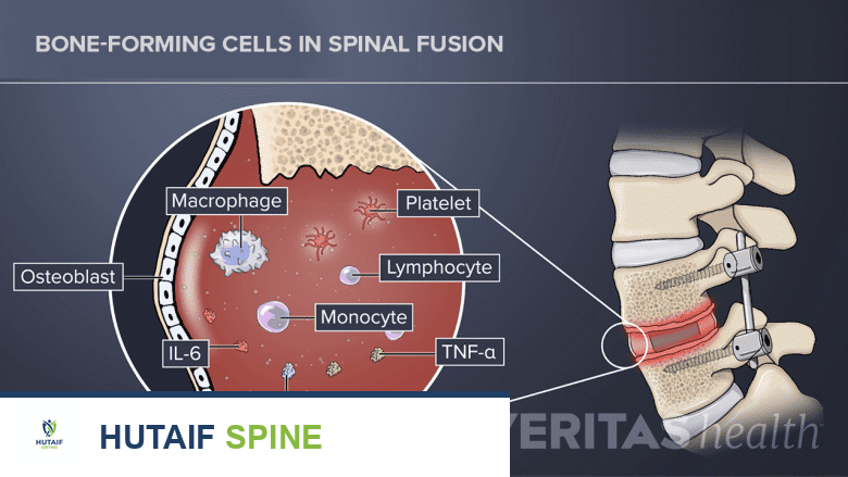 الطعم الذاتي للعظام: عظم المريض نفسه لشفاء مثالي وتثبيت الفقرات