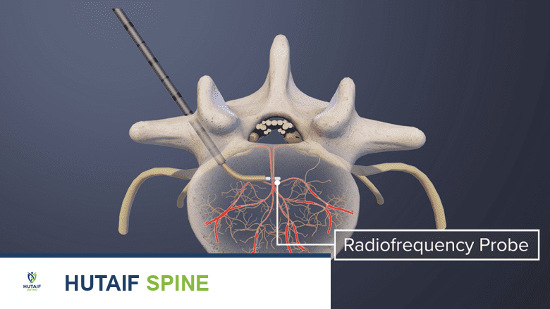 كي العصب الفقري القاعدي دليل شامل لعلاج آلام الظهر المزمنة مع الأستاذ الدكتور محمد هطيف