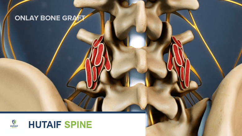 ترقيع العظام لدمج الفقرات: دليل شامل من الأستاذ الدكتور محمد هطيف في صنعاء