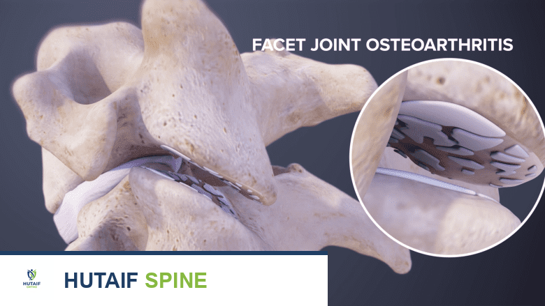 أسباب طقطقة الرقبة وأصوات الطحن والخشونة: دليل شامل للمرضى مع الأستاذ الدكتور محمد هطيف