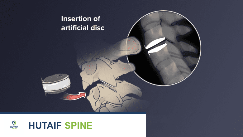 استبدال القرص الصناعي العنقي: حل متقدم لآلام الرقبة واستعادة الحركة