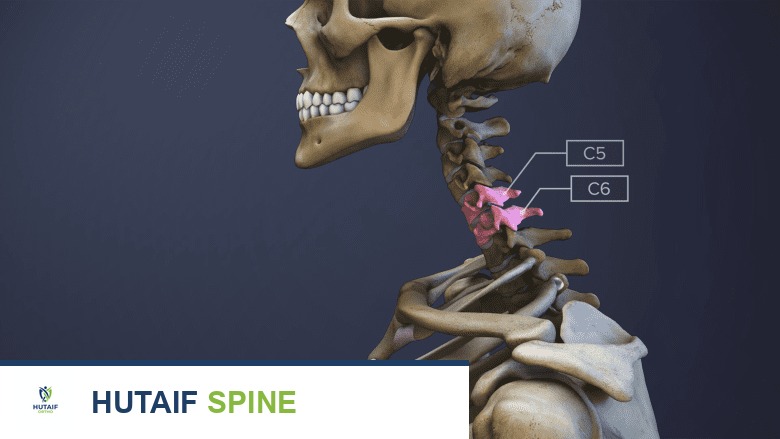 مرض القرص التنكسي العنقي الأسباب الأعراض والعلاج مع الأستاذ الدكتور محمد هطيف