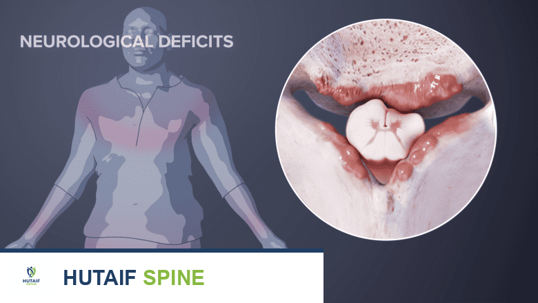 تضيق الثقبة العنقية: الأسباب، الأعراض، التشخيص، والعلاج الشامل مع الدكتور محمد هطيف