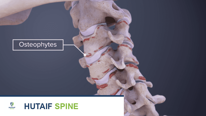 النتوءات العظمية الرقبية: كل ما تحتاج معرفته عن شوكات العظام في الرقبة وعلاجها مع الأستاذ الدكتور محمد هطيف