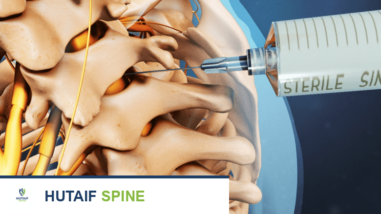 توضيح يظهر العمود الفقري مع إبرة مدخلة في الفقرة
