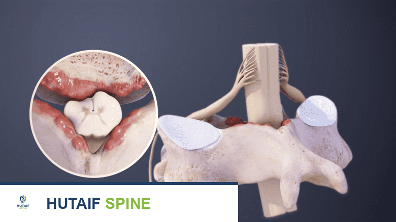 اعتلال النخاع الشوكي العنقي: دليل شامل من الأستاذ الدكتور محمد هطيف
