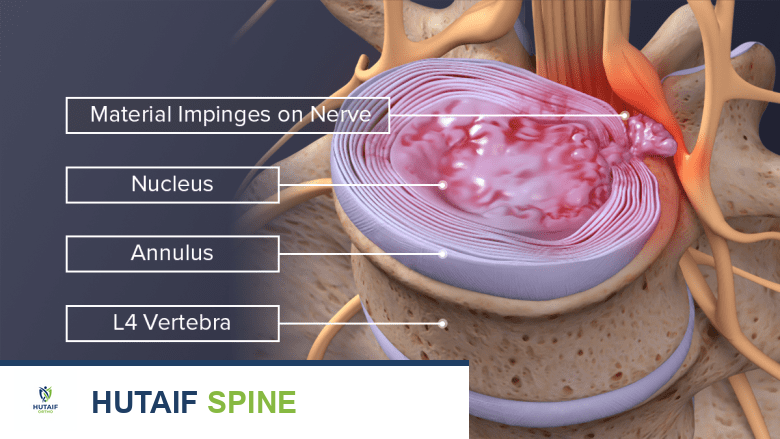 سقوط القدم الأسباب الأعراض وخيارات العلاج المتقدمة مع الأستاذ الدكتور محمد هطيف