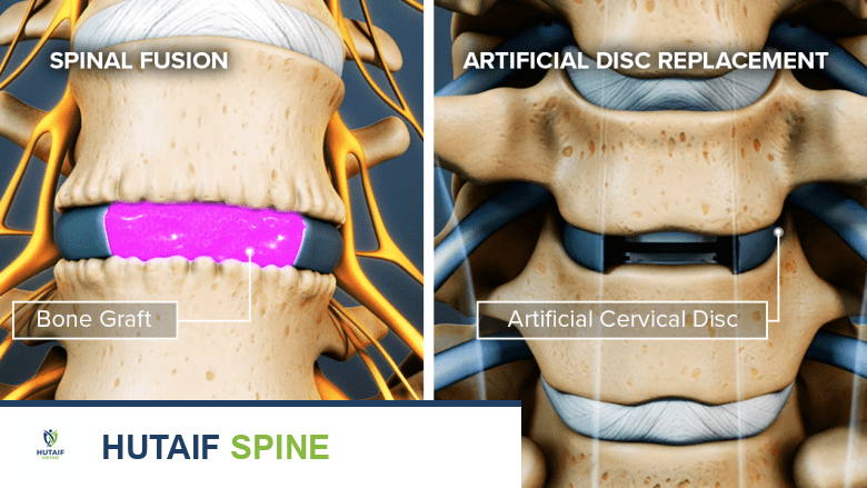 مقارنة شاملة بين استبدال القرص العنقي الصناعي ودمج الفقرات العنقية لمستويين: دليل المريض الشامل مع الأستاذ الدكتور محمد هطيف